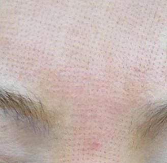 点阵激光除痘术后照片 点阵激光除痘术后照片