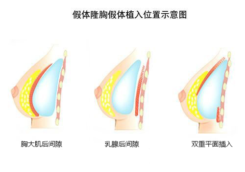 假体隆胸假体放置位置图示 假体隆胸假体放置位置图示