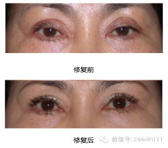 双眼皮修复前后对比图 双眼皮修复前后对比图