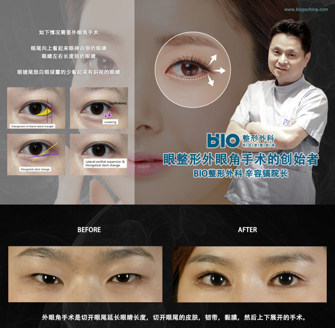 bio整形医院辛容镐院长解说开眼角手术