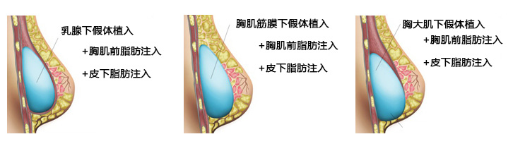 假体隆胸术式 假体隆胸术式