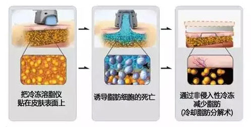 艺星酷塑冷冻溶脂原理解析 艺星酷塑冷冻溶脂原理解析