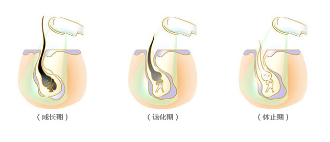 脱毛过程 脱毛过程