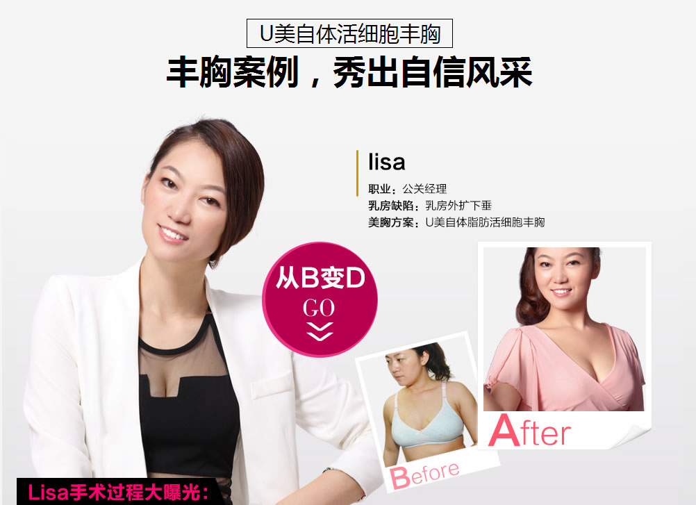 U美自体活细胞丰胸 丰胸案例,秀出自信风采 U美自体活细胞丰胸 丰胸案例,秀出自信风采