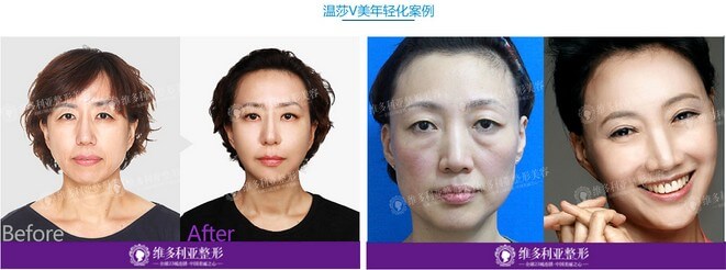 温莎V美年轻化案例 温莎V美年轻化案例