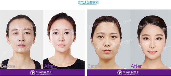 宝尼达微整案例 宝尼达微整案例