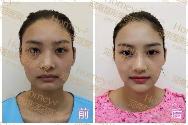 注射隆鼻前后对比实例 注射隆鼻前后对比实例
