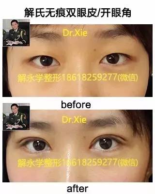 解永学美眼精雕术后即刻案例 解永学美眼精雕术后即刻案例