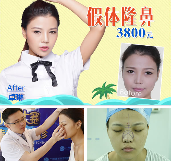 广州曙光假体隆鼻3800元 广州曙光假体隆鼻3800元
