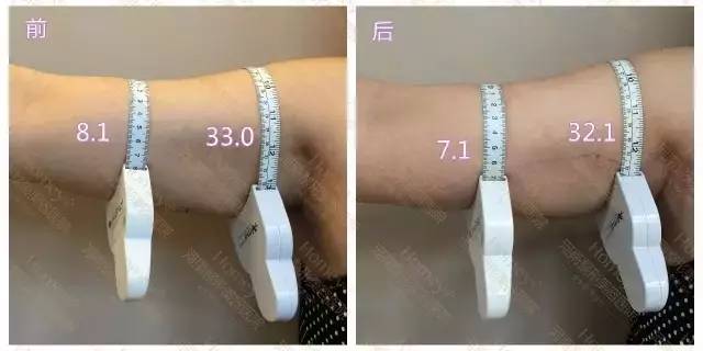 河南整形美容医院的优立塑真人案例 河南整形美容医院的优立塑真人案例