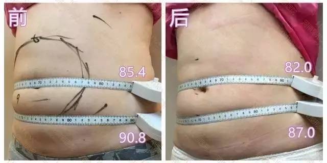 河南整形美容医院的优立塑真人案例 河南整形美容医院的优立塑真人案例