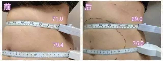 河南整形美容医院的优立塑真人案例 河南整形美容医院的优立塑真人案例