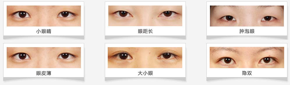 小清新迷你双眼皮适合于小眼睛、眼距长、肿眼泡、眼皮薄、大小眼、隐双等等患者 小清新迷你双眼皮适合于小眼睛、眼距长、肿眼泡、眼皮薄、大小眼、隐双等等患者