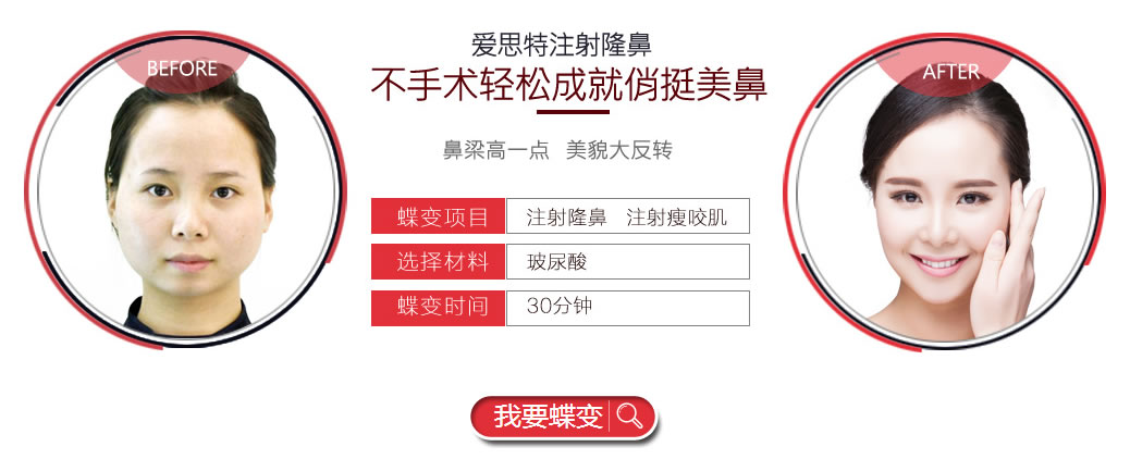<!--<i data=20240710 data-id=14448></i>-->玻尿酸注射隆鼻案例: <!--<i data=20240710 data-id=14448></i>-->玻尿酸注射隆鼻案例: