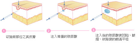 <!--<i data=20240710 data-id=14448></i>-->玻尿酸的手术方法 <!--<i data=20240710 data-id=14448></i>-->玻尿酸的手术方法