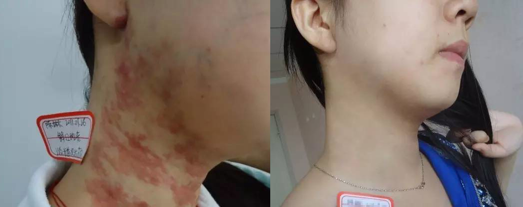 皮秒案例对比效果图 皮秒案例对比效果图
