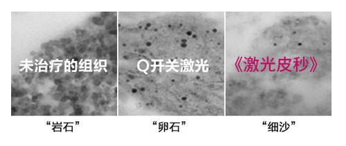 色素清除率更高 色素清除率更高
