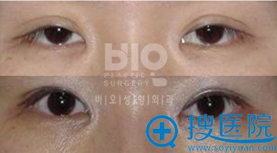 韩国bio整形外科医院辛容镐院长上睑下垂手术案例图片 韩国bio整形外科医院辛容镐院长上睑下垂手术案例图片