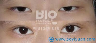 韩国bio整形外科医院辛容镐院长上睑下垂手术案例图片 韩国bio整形外科医院辛容镐院长上睑下垂手术案例图片