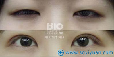 韩国bio整形外科医院辛容镐院长上睑下垂手术案例图片 韩国bio整形外科医院辛容镐院长上睑下垂手术案例图片