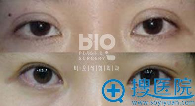 韩国bio整形外科医院辛容镐院长上睑下垂手术案例图片 韩国bio整形外科医院辛容镐院长上睑下垂手术案例图片