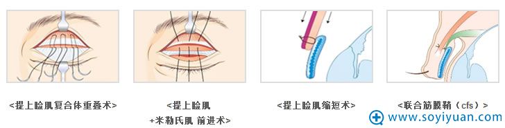 韩国bio整形外科医院辛容镐为我们讲解上睑下垂手术的原理 韩国bio整形外科医院辛容镐为我们讲解上睑下垂手术的原理
