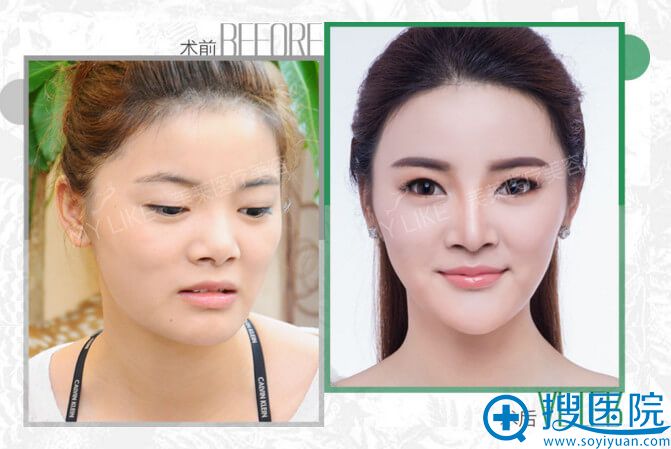 美莱韩式半定妆真人案例金融业女精英刘嫣然 美莱韩式半定妆真人案例金融业女精英刘嫣然