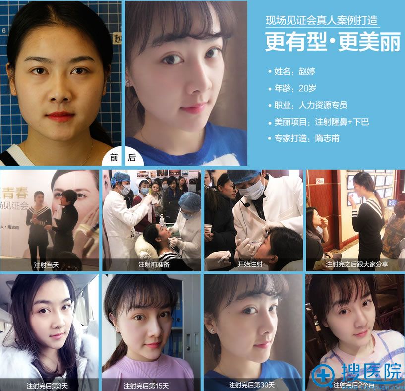 北京丽都整形医院玻尿酸注射过程大揭秘~ 北京丽都整形医院玻尿酸注射过程大揭秘~