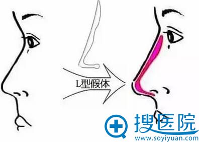 L型假体隆鼻 L型假体隆鼻