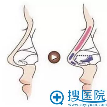 假体隆鼻 假体隆鼻