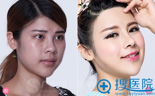 广州曙光案例:芷健——综合鼻修复+发际线调整前后对比 广州曙光案例:芷健——综合鼻修复+发际线调整前后对比