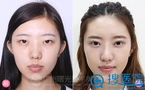 广州曙光案例:王诗月--鼻部综合整形+微创双眼皮+隆下颌 广州曙光案例:王诗月--鼻部综合整形+微创双眼皮+隆下颌