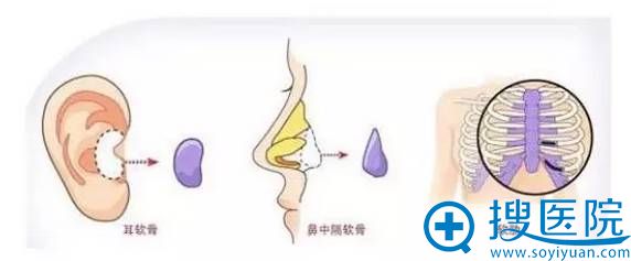 耳软骨隆鼻 耳软骨隆鼻
