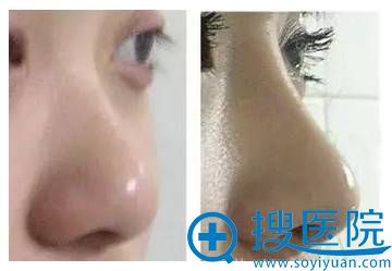 玻尿酸注射隆鼻案例对比 玻尿酸注射隆鼻案例对比