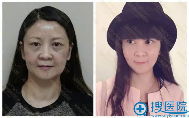 河美V-line美颜复合提升术案例 河美V-line美颜复合提升术案例