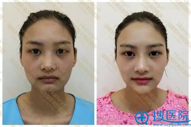 河美玻尿酸注射——苹果肌、下巴案例 河美玻尿酸注射——苹果肌、下巴案例