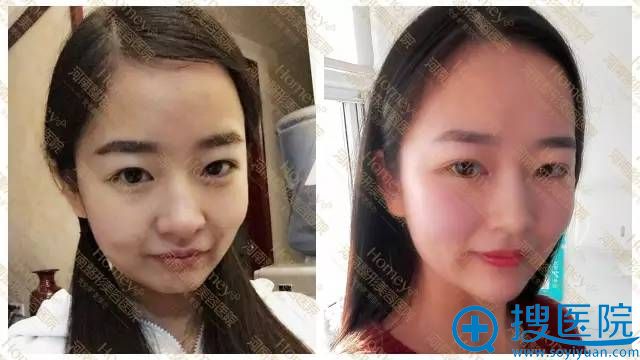 河美玻尿酸注射——苹果肌、木偶纹及口角、下巴案例 河美玻尿酸注射——苹果肌、木偶纹及口角、下巴案例