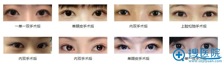 较后搜医院小编准备了深圳非凡整形医院的双眼皮案例图 较后搜医院小编准备了深圳非凡整形医院的双眼皮案例图