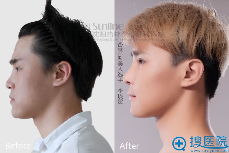 沈阳杏林隆鼻手术真人整形前后对比案例展示: 沈阳杏林隆鼻手术真人整形前后对比案例展示: