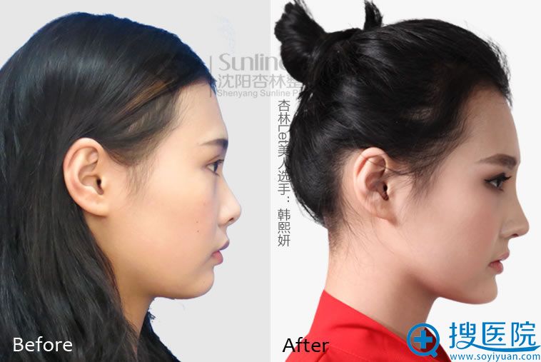 沈阳杏林隆鼻手术真人整形前后对比案例展示: 沈阳杏林隆鼻手术真人整形前后对比案例展示: