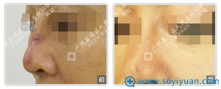 3、广州荔湾区人民医院重度奥美定取出鼻部教学案例图 3、广州荔湾区人民医院重度奥美定取出鼻部教学案例图