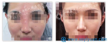 2、广州荔湾区人民医院中度奥美定取出修复面部教学案例 2、广州荔湾区人民医院中度奥美定取出修复面部教学案例