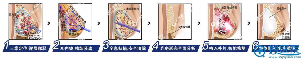 广州荔湾区人民医院清奥修复手术过程 广州荔湾区人民医院清奥修复手术过程