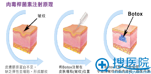 瘦脸除皱注射原理 瘦脸除皱注射原理