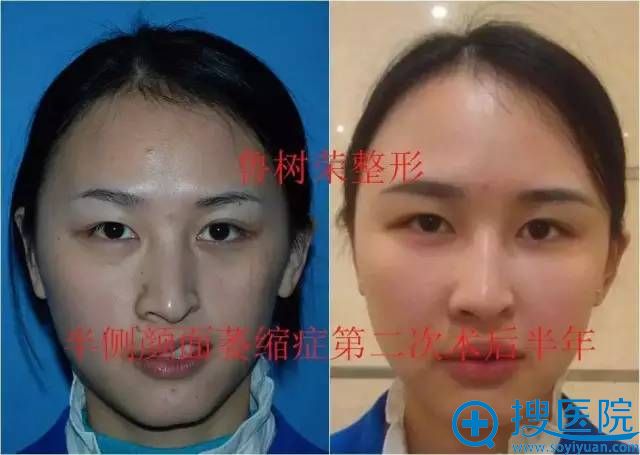 脂肪医生鲁树荣教授的案例展示:脂肪移植矫正半侧颜面萎缩 脂肪医生鲁树荣教授的案例展示:脂肪移植矫正半侧颜面萎缩