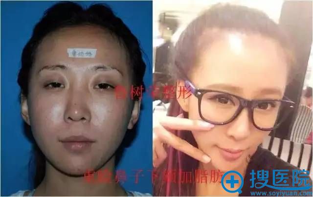 脂肪医生鲁树荣教授的案例展示:脂肪移植联合其他面部手术 脂肪医生鲁树荣教授的案例展示:脂肪移植联合其他面部手术
