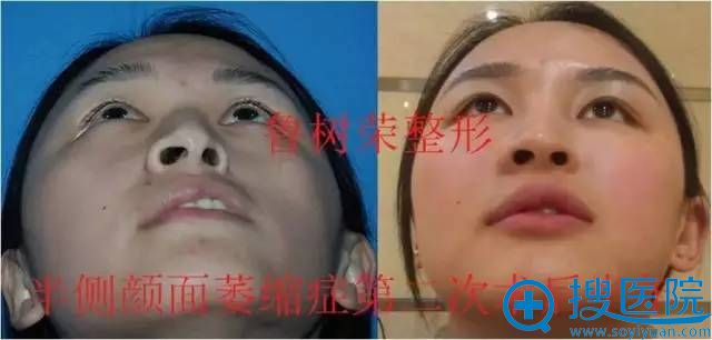 脂肪医生鲁树荣教授的案例展示:脂肪移植联合其他面部手术 脂肪医生鲁树荣教授的案例展示:脂肪移植联合其他面部手术