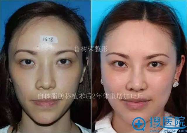 脂肪医生鲁树荣教授的案例展示:脂肪移植中面部塑造苹果肌 脂肪医生鲁树荣教授的案例展示:脂肪移植中面部塑造苹果肌