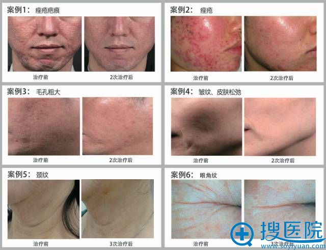 上海丽铂INTRAcel 黄金微针案例展示 上海丽铂INTRAcel 黄金微针案例展示
