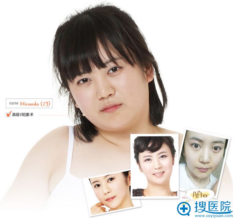 ����tl����ҽԺ �߼�V�����������Ӵ�������v-lineС��